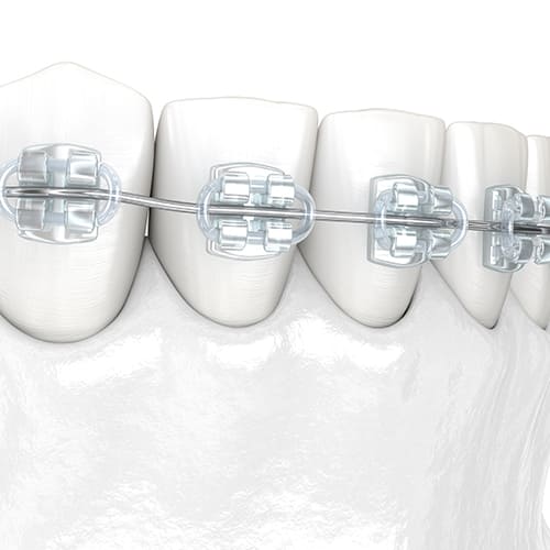 矯正後に重要な「保定期間」