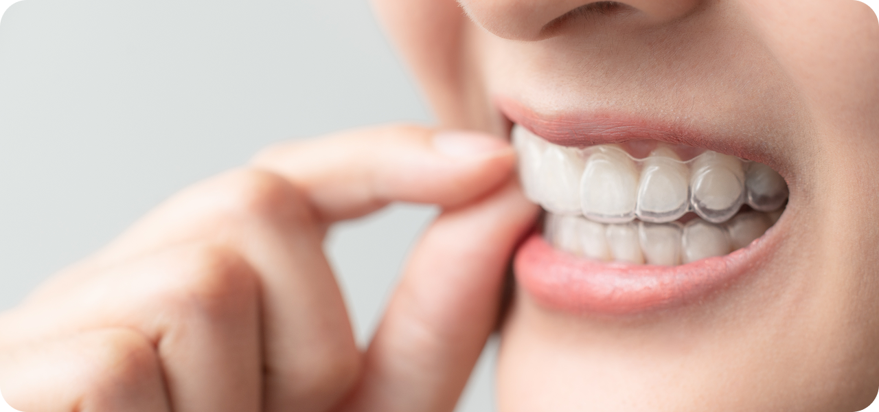 マウスピース矯正